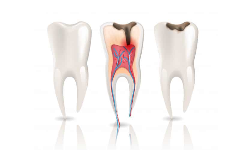 Is Root Canal for Kids necessary?