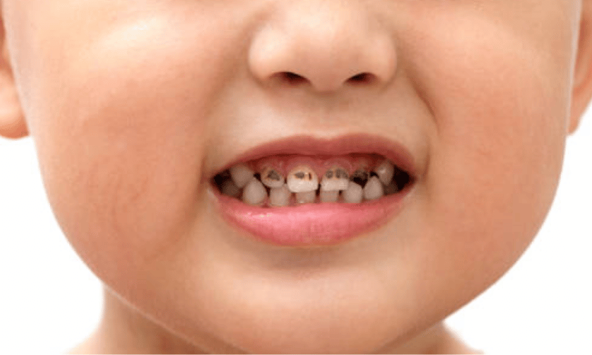 Do Cavities in Baby Teeth Really Need to Be Filled?