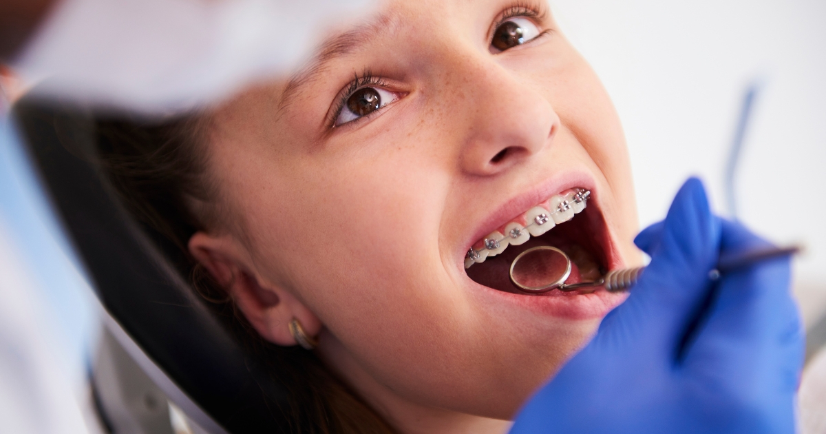 when should children get braces